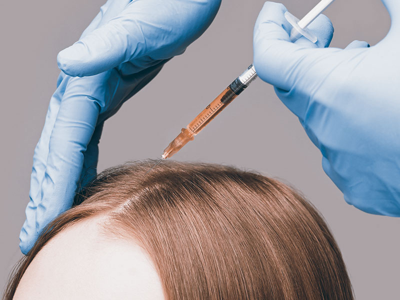 mesoterapia per la caduta dei capelli