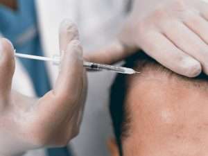 PRP per la caduta dei capelli