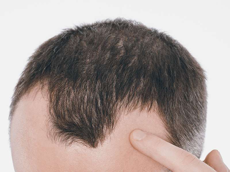 Alopecia androgenetica maschile