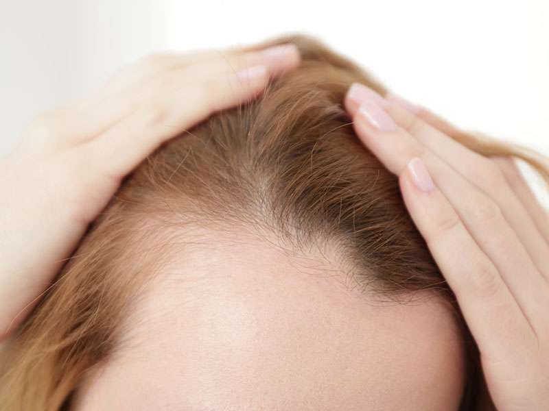 Tipi di alopecia femminile e come trattarli