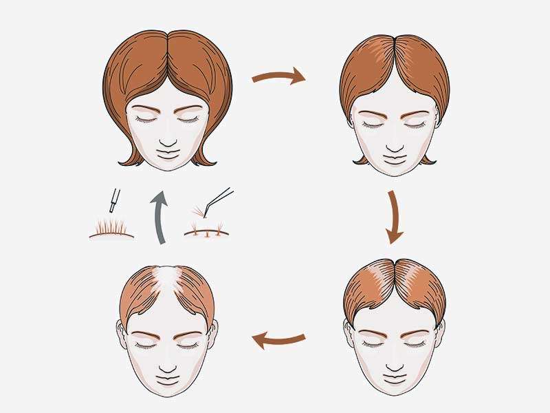 Perdita di capelli nelle donne: calvizie femminile e altro