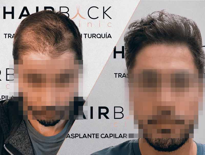 Risultato Trapianto di capelli in Turchia