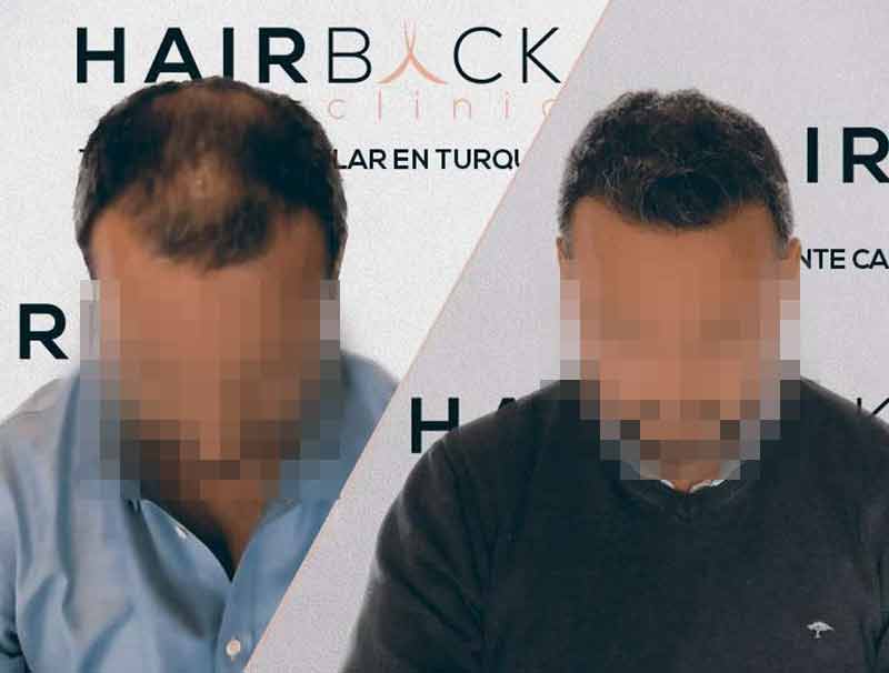 Risultato Trapianto di capelli in Turchia