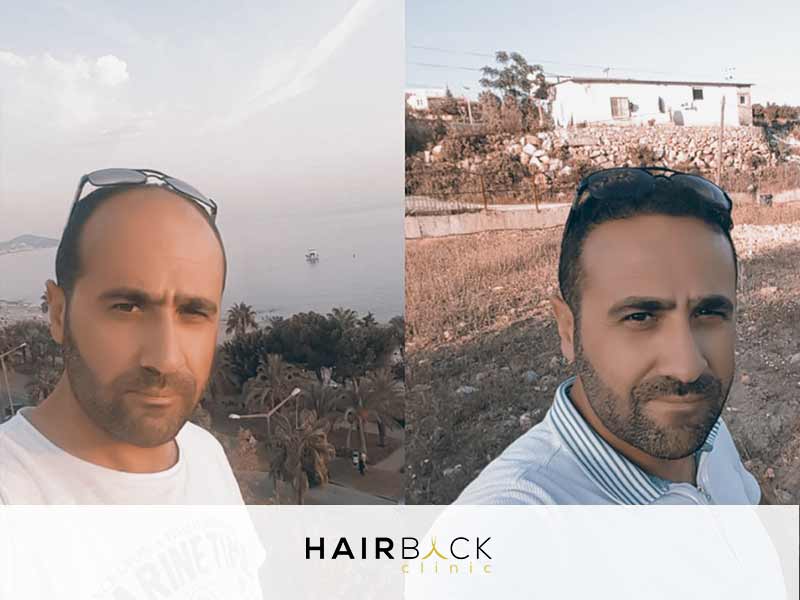 Risultato del trapianto di capelli in Turchia