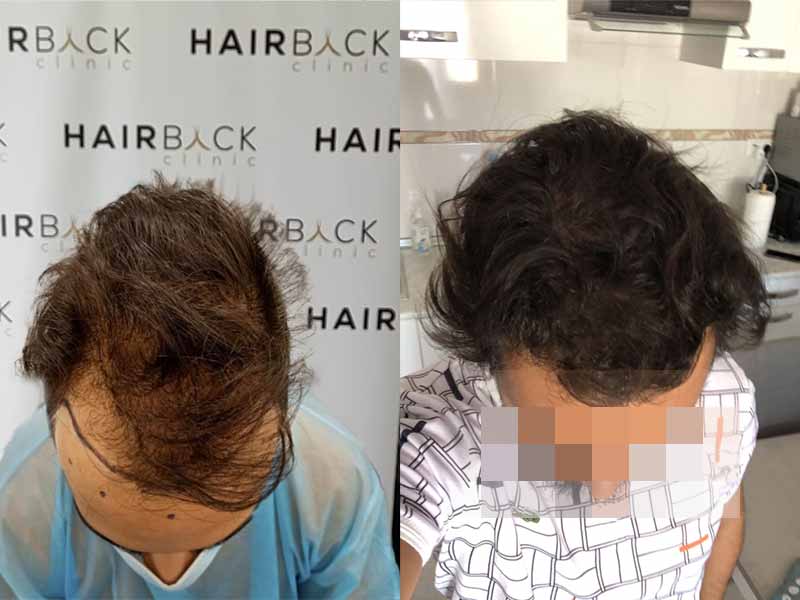 Risultato del trapianto di capelli a Istanbul