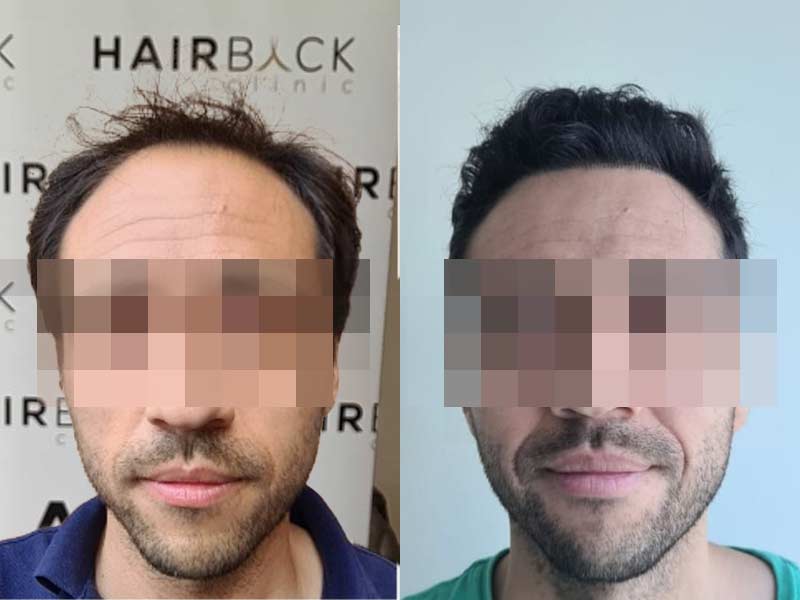 Risultato del trapianto di capelli in Turchia