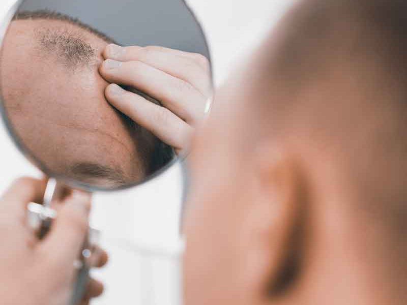 5 fasi di ricrescita dopo un trapianto di capelli