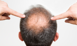 Alopecia maschile: calvizie maschile