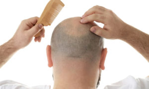 Alopecia negli uomini