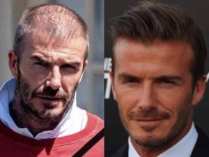 Atleti famosi con trapianto di capelli - David Beckham