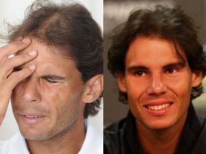Atleti famosi con trapianto di capelli - Rafael Nadal