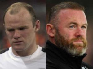 Atleti famosi con trapianto di capelli - Wayne Rooney