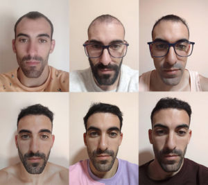 Trapianto Capelli Prima E Dopo