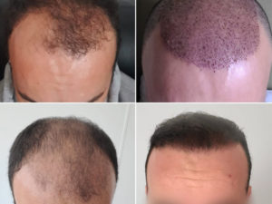 Trapianto Capelli Prima E Dopo