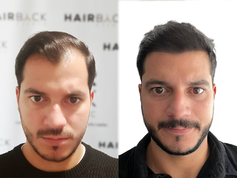 Trapianto Capelli Prima E Dopo Turchia