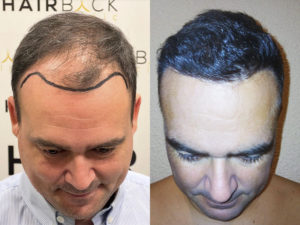 Trapianto Capelli Prima E Dopo Turchia