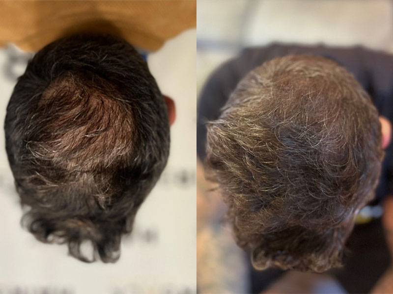 Trapianto Capelli Prima E Dopo Turchia