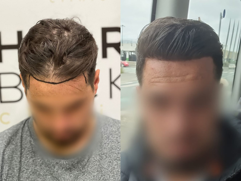 Trapianto Capelli Prima E Dopo Turchia