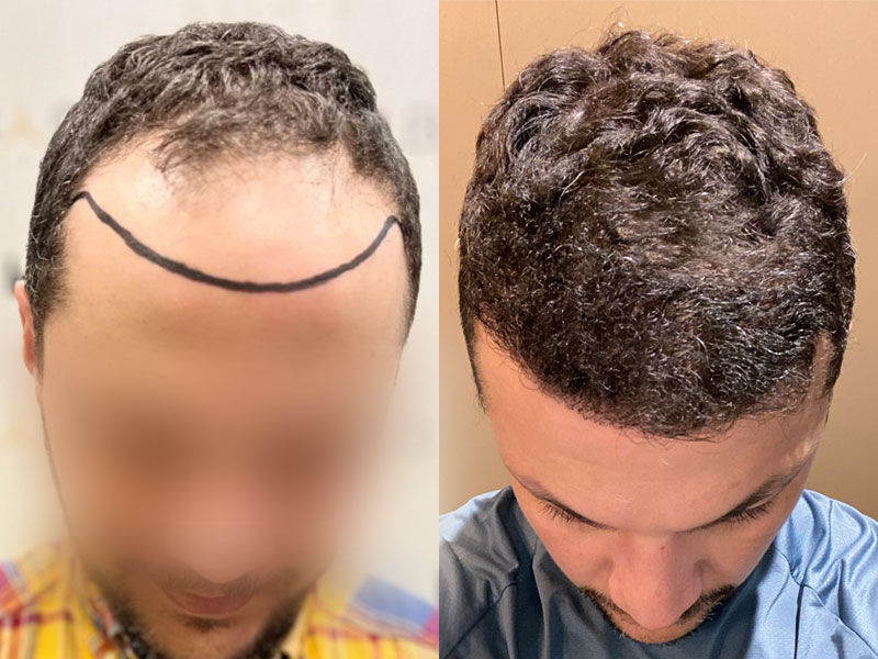 Trapianto Capelli Prima E Dopo Turchia